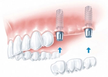 Multiple Adjoining Tooth Implants