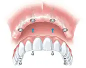 Full Arch Implant