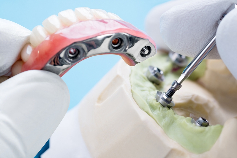 dentures stabilised by dental implants